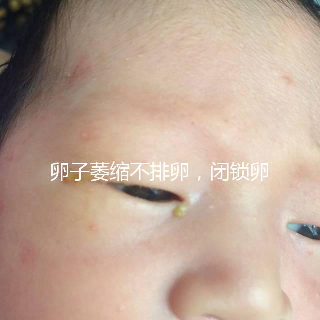 卵子萎縮不排卵，閉鎖卵泡形成原因與這4點有關