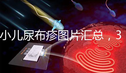 小兒尿布疹圖片匯總，3種類型癥狀大不一樣