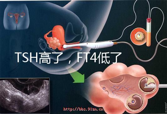 TSH高了，FT4低了，需要補碘嗎？